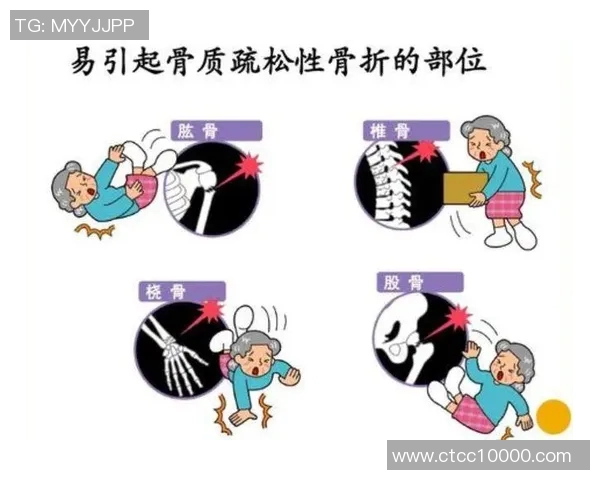 足球明星频繁骨折的原因探讨与运动伤害的深层次分析